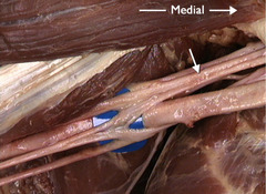 <p>In this anterior view of the right axilla, identify the structure indicated by the arrow.</p>