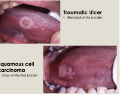 <p>Malignant epithelial neoplasm of oral mucosa.</p><p>- Most common oral cancer </p><p>-a type of cancer that starts in the flat, thin squamous cells lining the inside of the mouth and lips</p>