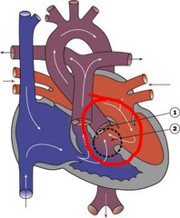 <p>A congenital heart defect where the aorta is positioned directly over a ventricular septal defect (VSD), instead of over the left ventricle.</p>