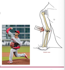 <p>•Falling onto an outstretched and supinated arm</p><p>•Medial collateral ligament (most likely the anterior fibers) injury</p><p>•Compression of humeroradial joint --> fracturing radial head</p><p>•Repetitive stretching of the ligament</p><p>•Elite level baseball pitcher</p><p>•MCL reconstruction --> Tommy John surgery</p>