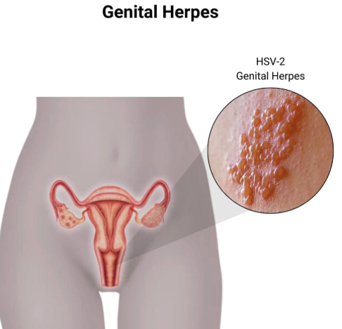 <p>herpes HSV 1/2</p>