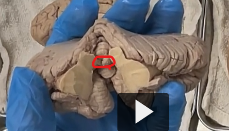 <p>superior medullary velum </p><p><strong>Definition</strong> </p><p>The <strong>superior medullary velum</strong> is a <strong>thin sheet of white matter</strong> that forms part of the <strong>roof of the fourth ventricle</strong>.</p><ul><li><p>It connects the <strong>left and right superior cerebellar peduncles</strong></p></li><li><p>Lies <strong>just beneath the lingula of the cerebellum</strong></p></li><li><p>Forms the <strong>upper portion of the fourth ventricle roof</strong></p></li></ul><p> <strong>Etymology</strong> </p><ul><li><p><strong>Superior</strong>: Latin <em>superior</em> = <strong>above</strong></p></li><li><p><strong>Medullary</strong>: from Latin <em>medulla</em> = <strong>marrow / inner core</strong> (referring to brainstem/white matter)</p></li><li><p><strong>Velum</strong>: Latin <em>velum</em> = <strong>veil or sail</strong></p></li></ul><p> Literal meaning:<br><strong>“upper veil of the medulla (brainstem region)”</strong></p>