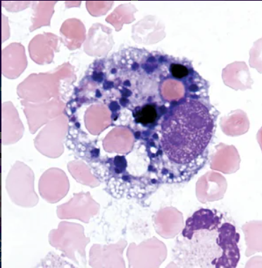 <p>What are siderophages in CSF?</p><p>a. Macrophages containing hemosiderin from hemoglobin breakdown </p><p>b. Macrophages containing lipid droplets from cell membrane degradation </p><p>c. Macrophages containing nuclear debris from apoptotic cells </p><p>d. Monocytes accumulating ferritin due to increased serum iron levels </p>