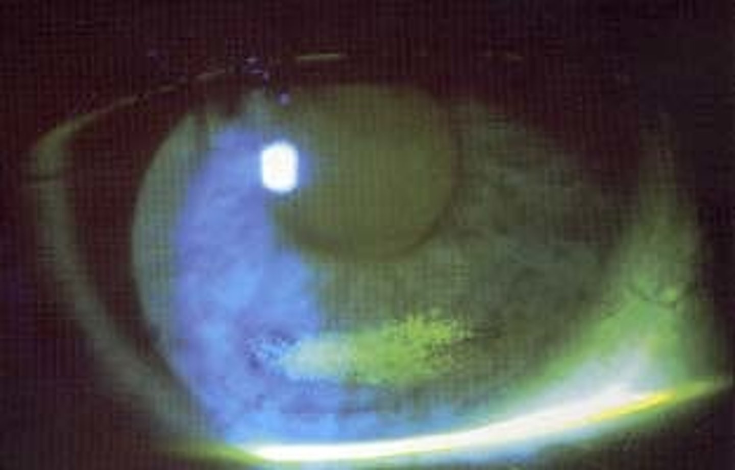 <p>presents parallel to the inferior limbus and is due to dehydrated contact lenses associated with insufficient post-lens tear film. Patients may have complaints of mild discomfort.</p>