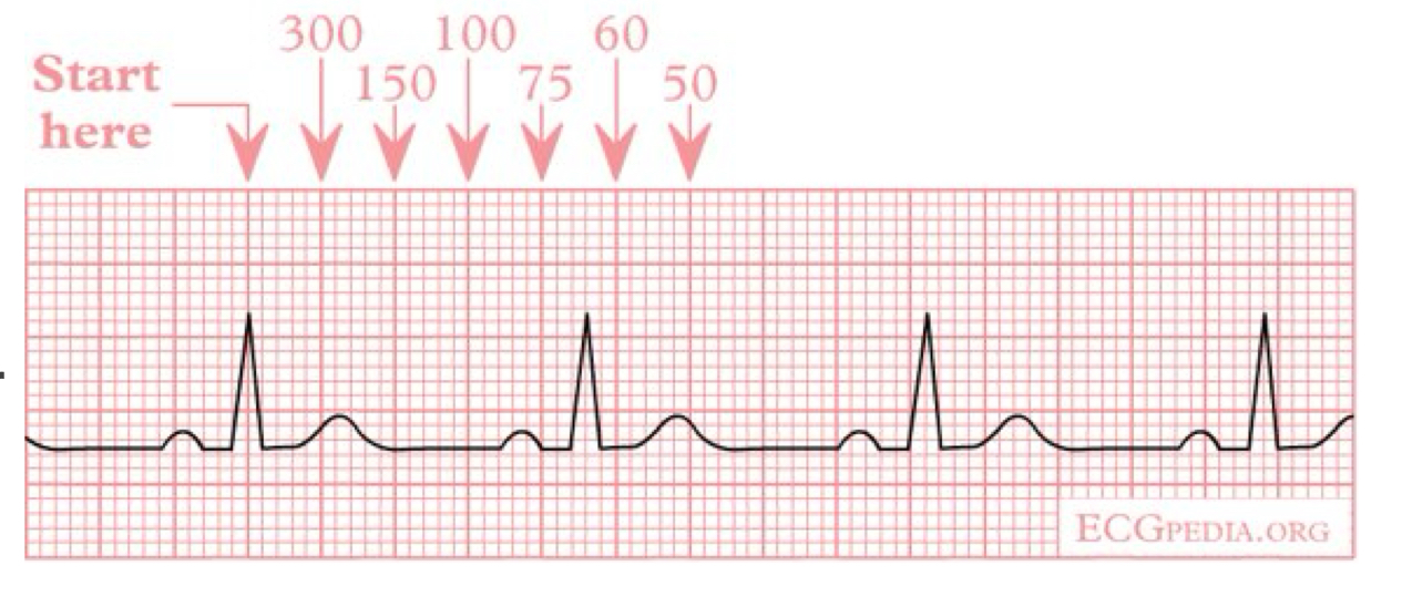 <ul><li><p>find R wave most closely lies on dark line</p></li><li><p>recite numbers on each <strong>large box</strong> until get to the next R wave</p></li><li><p><strong>doe NOT work foe irregular rhythms</strong></p></li></ul><p></p>