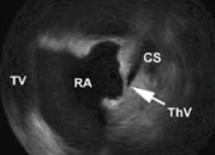 <ul><li><p>a flap of <strong>endocardial tissue</strong> that <u>guards</u> the <span style="color: rgb(0, 139, 255);">Coronary Sinus opening</span> <strong>into </strong>the <span style="color: rgb(0, 109, 255);">RA</span></p></li><li><p>often <u>continuous w/</u> the <span style="color: rgb(0, 109, 255);">Eustachian valve</span></p></li><li><p>not typically referenced in clinical practice</p></li></ul><p></p>
