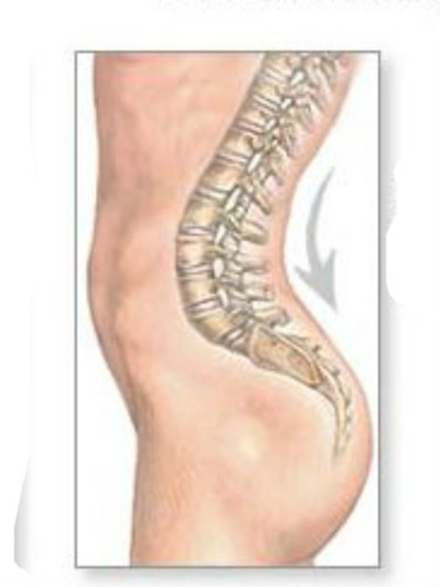 <p>exaggerated convexity of the lumbar area</p>