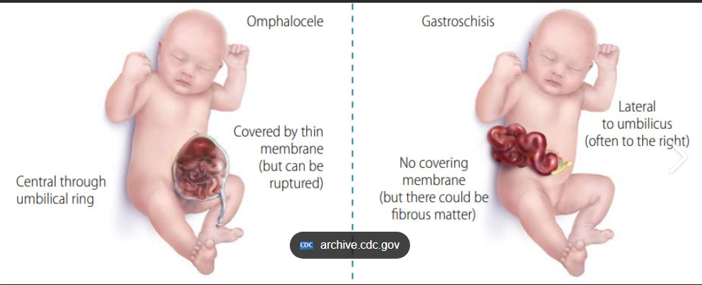 <p><strong>Omphalocele </strong></p><ol><li><p><span style="color: rgb(240, 103, 103);"><strong>organs stick out </strong></span>through the umbilical cord</p></li><li><p><strong><u>covered </u></strong>by <span style="color: rgb(121, 105, 223);"><strong>thin sac</strong></span></p></li></ol><p></p><p><strong>Gastroschisis  </strong></p><ol><li><p>organs stick out <span style="color: rgb(221, 97, 97);"><strong>2-5 cm RIGHT</strong></span> of cord</p></li><li><p><span style="color: rgb(106, 128, 226);"><strong>NO sac covering</strong> </span><span style="color: rgb(10, 12, 21);">so organs</span><span style="color: rgb(106, 128, 226);"> <strong>exposed</strong></span></p></li></ol><p></p>