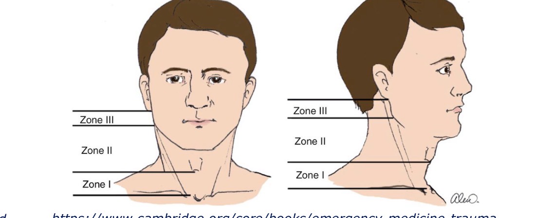 <p>Kas yra kaklo trauma II zona ir kas joje yra?</p>
