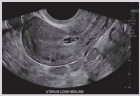 <p><span style="background-color: transparent;">Gestational sac implants into myometrium of previous c-section scar</span></p>
