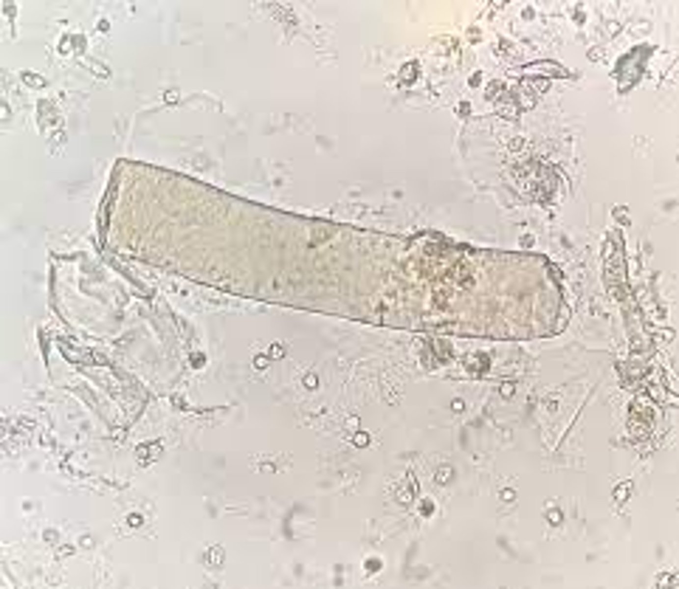 <p>Renal failure</p>