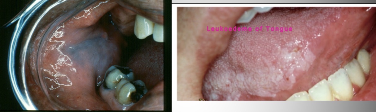 <p><span><span>Leukoedema</span></span></p>