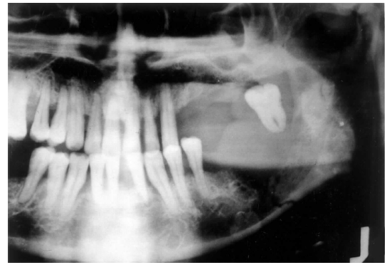 <p>metastatic tumors of the jaws</p>