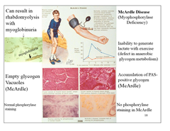 <p>AR McArdle disease (skeletal muscle glycogen phosphorylase deficiency)</p>
