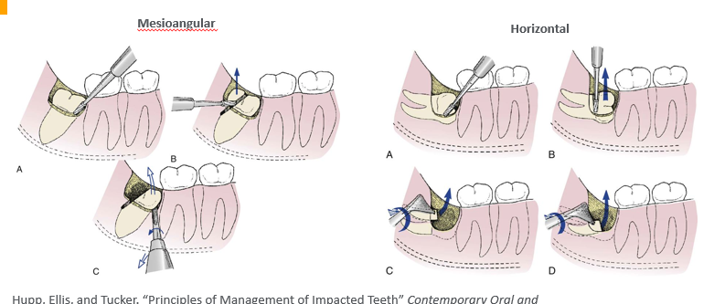 <p>-section tooth</p>