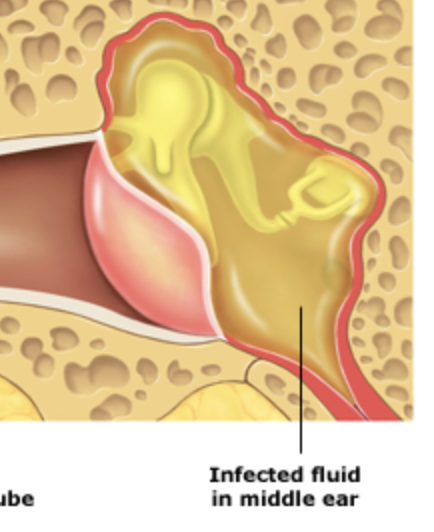 <p>otitis media</p>