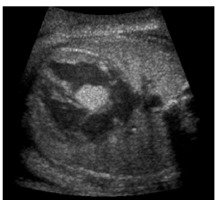 <p>May influence the conduction system, cause an outflow track obstruction, CHF, AV regurgitation or sudden death from an arrhythmia </p><p>(May need premature delivery and urgent surgery)</p>