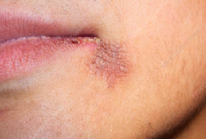 <p>masses of dead tissue caused by burns or exposure to corrosive agents</p><p>tissue necrosis leads to dry, leathery scabs (eschars), which may later slough off, leaving an ulcer.</p>