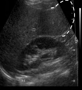 <p>When right lobe of live extends below lower pole of right kidney</p>