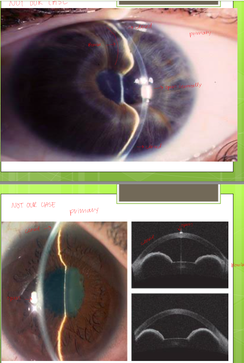 <p>iris bombe (convex iris) </p><p>open centrally and closed peripherally </p><p>NOT OUR DX</p>