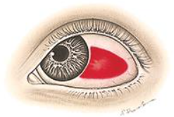 <p>leakage of blood outside vessels (homogenous, sharply demarcated, red area)</p><p>benign</p><p>resolves over 2 wk</p>