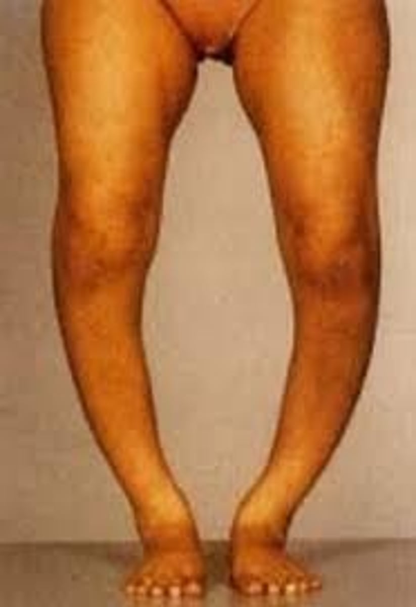 <p>osteomalacia in children</p><p>typically results in bowed legs and other bone deformities</p><p>caused by a deficiency of vitamin D and/or a deficiency in calcium</p>