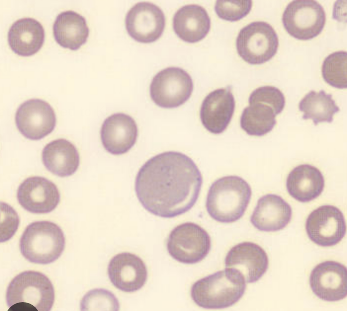 <p>What are macrocytes?</p>