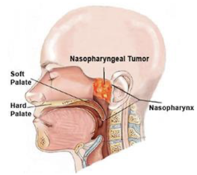 <p>• <strong>Mostly found in the nasopharynx &amp; linked to the EBV virus.</strong></p><p>• <strong>High prevalence in Southern China and Africa, </strong><span style="color: green;"><strong>due to both genetic</strong></span></p><p><span style="color: green;"><strong>and environmental factors</strong></span></p><p>• Chinese diet of a high amount of smoked fish, <strong>which contain nitrosamines, well known carcinogens </strong>(environmental).</p><p>• <strong>Nasal obstruction</strong>, <span style="color: red;">discharge, bleeding, deafness</span></p><p>•<strong> Responds well to radiotherapy;</strong> 5 year survival rates of about 50%</p>