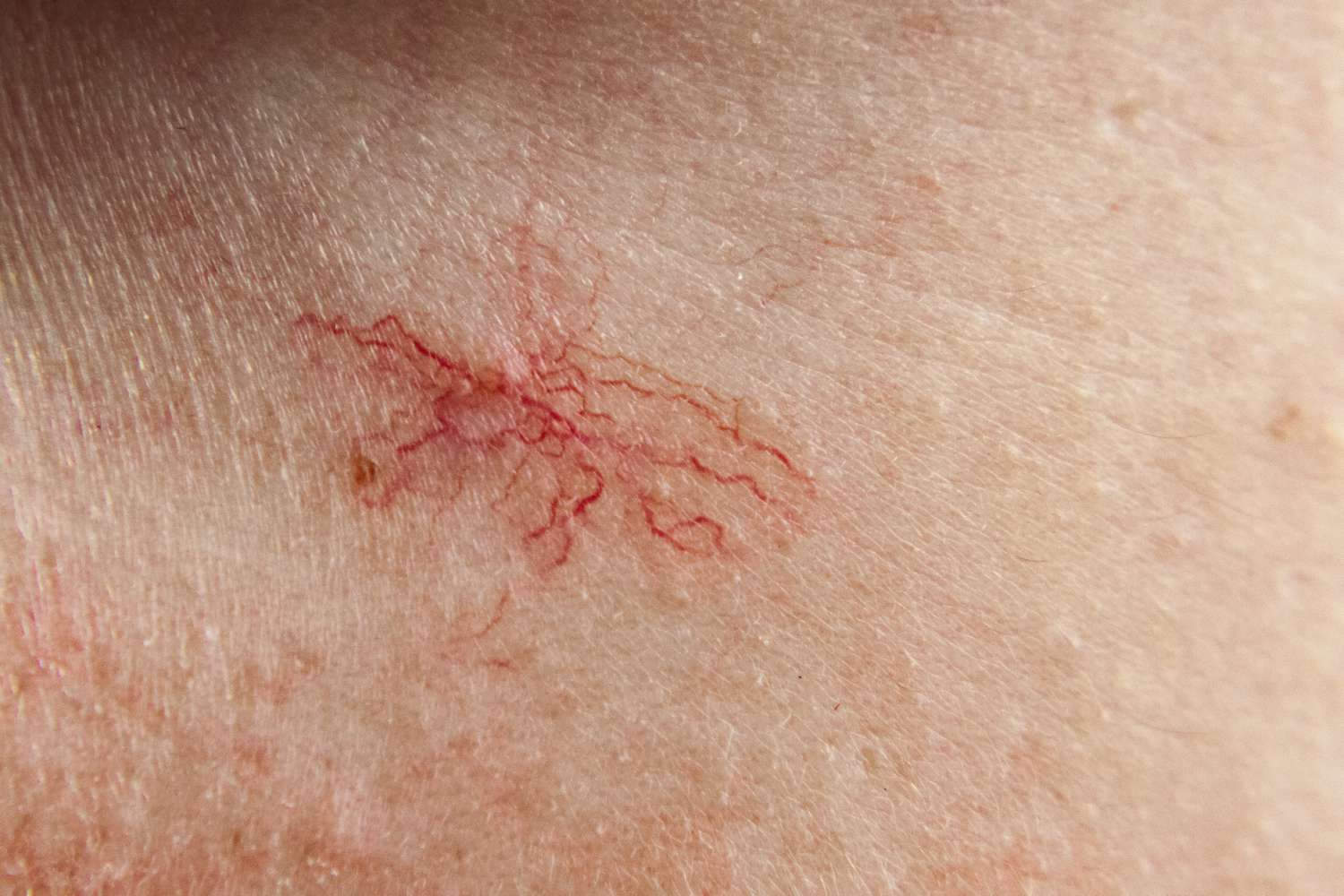 <p>occur due to extra blood volume and estrogen during pregnancy</p><ul><li><p>appear with tiny red centers with radiating branches</p></li><li><p></p></li></ul><p></p>