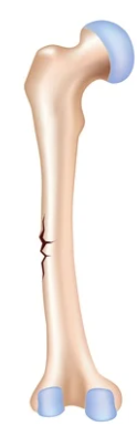 <p><strong>Incomplete fracture</strong> where one cortex breaks while the opposite cortex bends, caused by bending force in <strong>immature bone</strong>, common in <strong>young animals</strong>.</p>