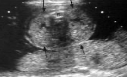 <ul><li><p>both kidneys symmetrically enlarged </p></li><li><p>cysts are too small </p></li><li><p>renal function severely impaired</p><ul><li><p>oligo, bladder may not be seen</p></li></ul></li></ul><p></p>