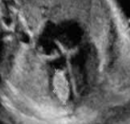 <ul><li><p><span style="background-color: transparent;">Most common benign cardiac tumor (prenatally diagnosed)</span></p></li><li><p><span style="background-color: transparent;">Associations:</span></p><ul><li><p><span style="background-color: transparent;">Tuberous sclerosis (60-80%)</span></p></li><li><p><span style="background-color: transparent;">Arrhythmias</span></p></li><li><p><span style="background-color: transparent;">Valve obstruction</span></p></li></ul></li><li><p><span style="background-color: transparent;">US findings:</span></p><ul><li><p><span style="background-color: transparent;">Echogenic mass within RV or LV</span></p></li></ul></li></ul><p></p>
