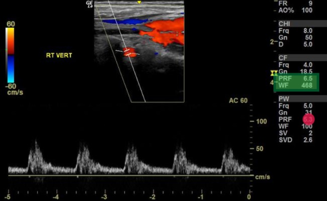 <p>What does this waveform artifact represent?</p>
