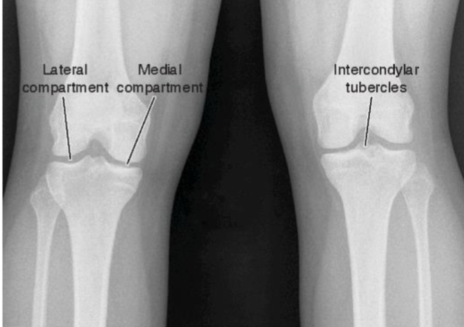 <ul><li><p><span><strong>Bicondylar (or double condyloid) synovial joint</strong></span></p></li></ul><p></p><ul><li><p><span><strong>Degrees of freedom</strong></span></p><ul><li><p><span> 2 rotatory available</span></p></li><li><p><span> 1 obvious DoF in function</span></p></li></ul></li></ul><p></p><ul><li><p><span><strong>Convex femoral condyles/concave tibial plateau</strong></span></p></li></ul><p></p>