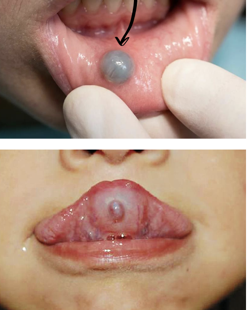 <p>what is this, and why is the lesion blueish?</p>