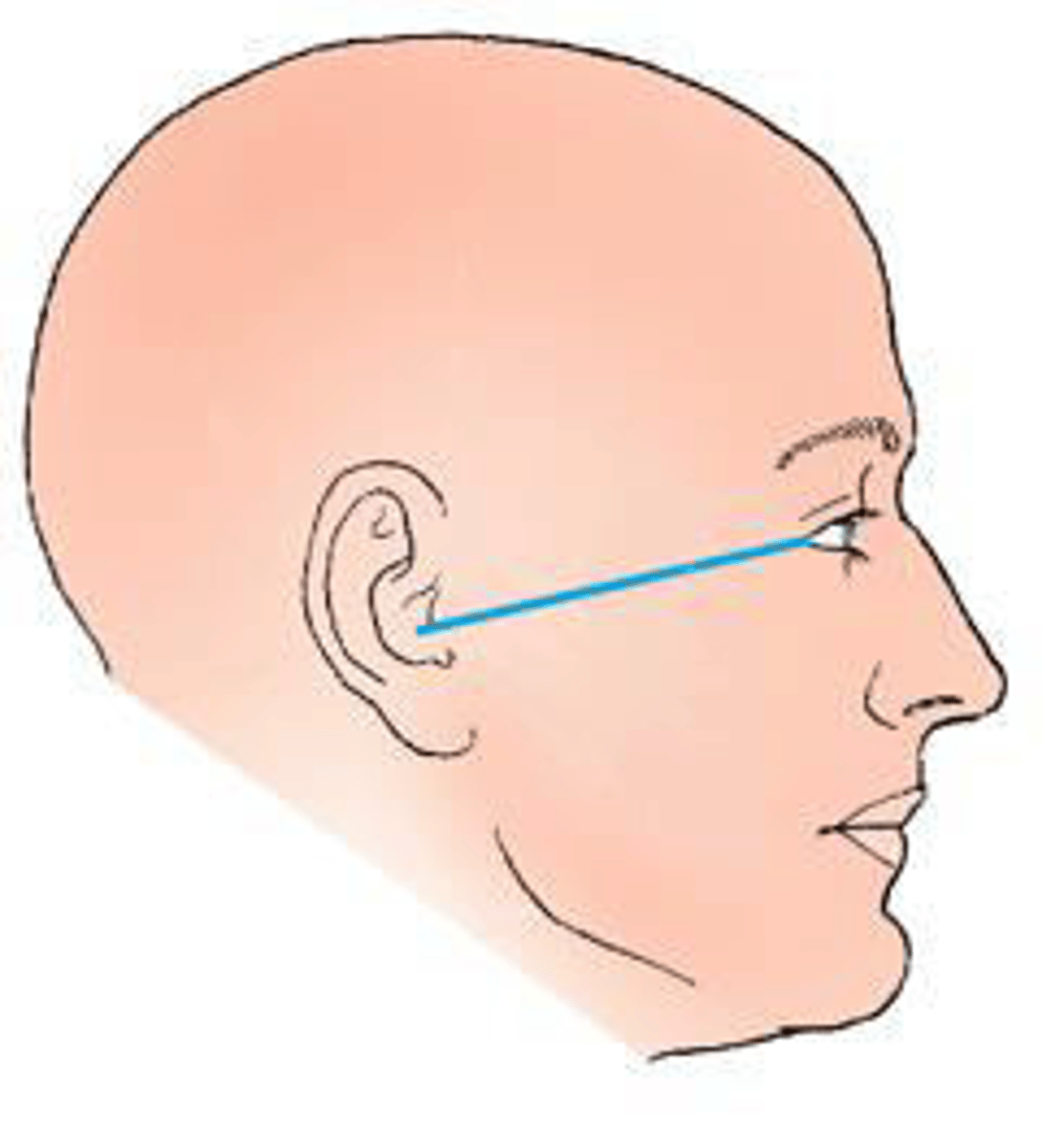 <p>The topographic line shown in the figure below is the:</p><p>a. glabellomeatal.</p><p>b. orbitomeatal.</p><p>c. acanthiomeatal.</p><p>d. infraorbitomeatal.</p>