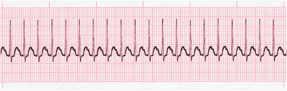 <p>what heart rhythym is this</p>