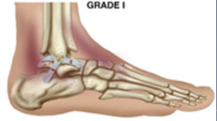 <p>- Incomplete tear</p><p>- Swelling, ecchymosis</p><p>treatment: immobilization</p>
