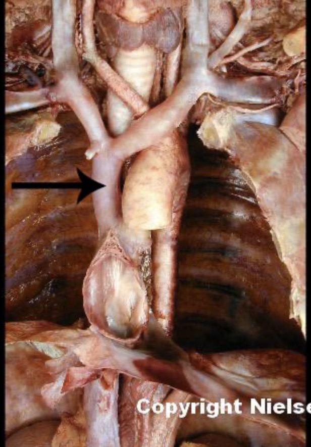 <p>The indicated vessel is the _. The indicated vessel drains the _, neck, _ limbs, and thorax. </p>