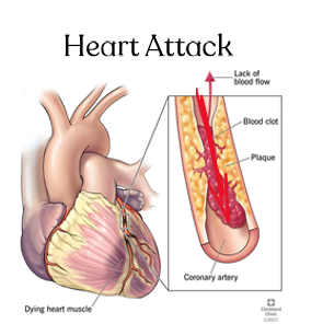 <p>cause: blocked coronary artery</p><p>Effects on circulation: O2 cut off = heart tissue dies</p><p>treatment: aspirin, lifestyle changes </p><p></p>