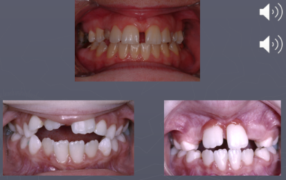 <p>What is another soft tissue feature factor that strongly indluences relapse after correction?</p>