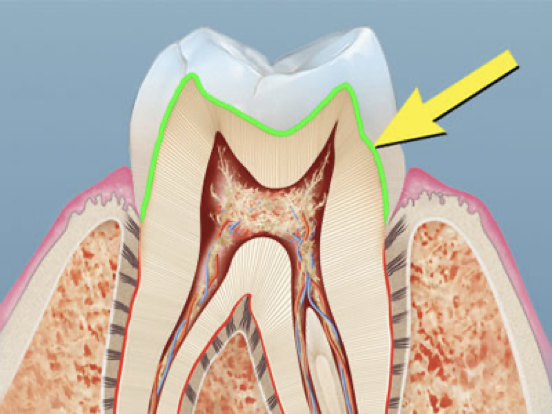 <p>Dentino-enamel junction (DEJ)</p>