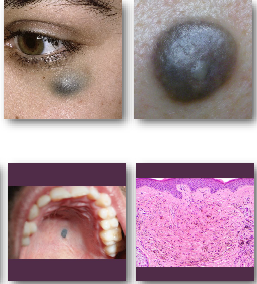 <ul><li><p>blue-grey appearance</p></li><li><p>common site is on palate</p></li><li><p>appears like amalgam tattoo </p></li></ul><p></p>