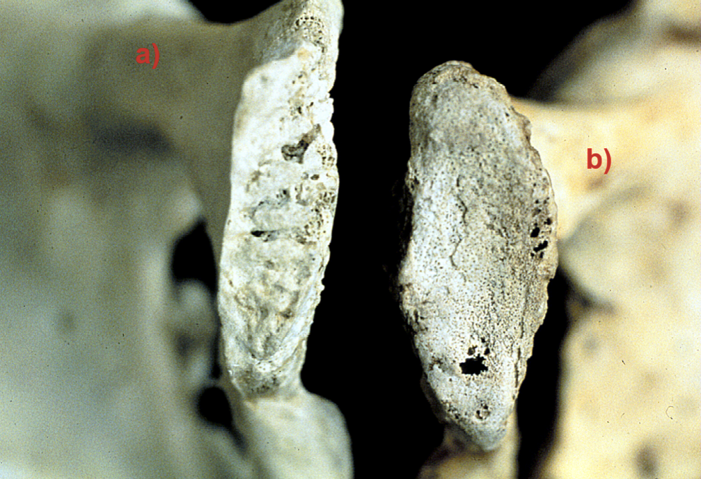 <p>which pubic symphyses is younger?</p>