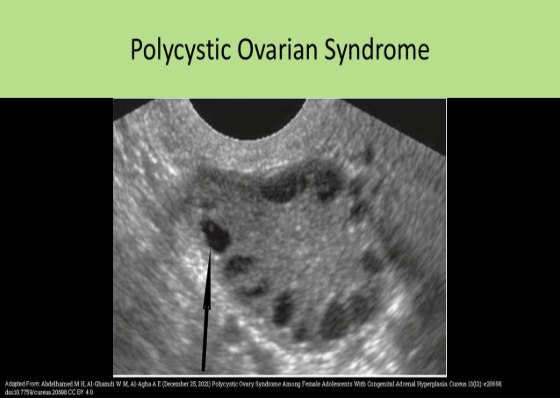 <p>D. <10mm along the periphery of the ovary.</p><p>Polycystic ovarian disease usually demonstrates multiple follicles <10mm along the periphery of the ovary. This finding is described as the string of pearls sign.</p>