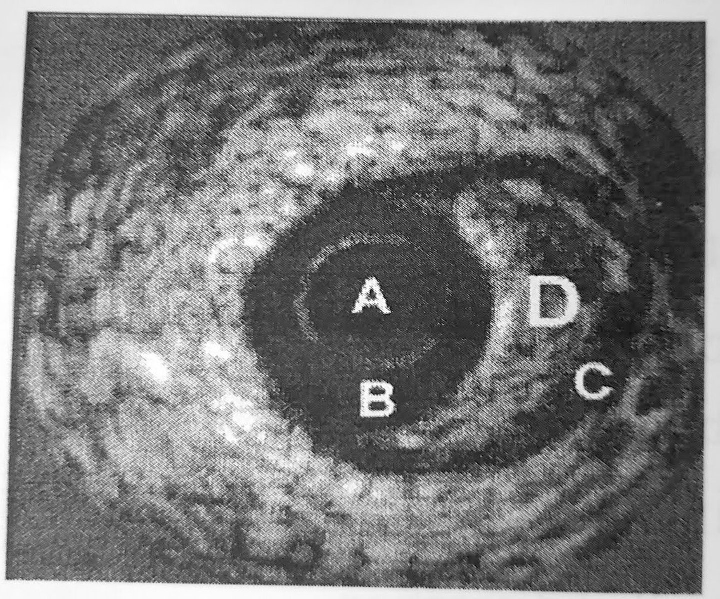<p>Catheter</p>