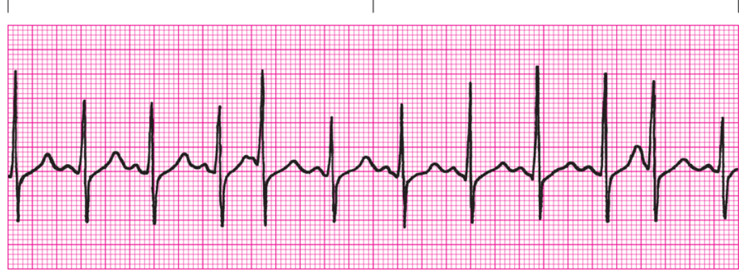 <ol><li><p>Regularity?</p></li><li><p>Rate</p></li><li><p>P Waves</p></li><li><p>PRI</p></li><li><p>QRS</p></li><li><p>Interpretation</p></li></ol><p></p>