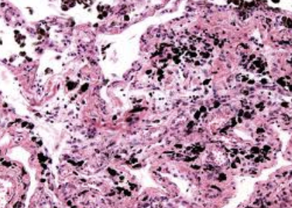 <ol><li><p>Sickle Cell Anemia</p></li><li><p>Atherosclerosis</p></li><li><p>Adenocarcinoma of Kidney</p></li><li><p>Osteogenic Sarcoma of Bone</p></li><li><p>Tattoo in Human Skin</p></li><li><p>Neurilemmoma</p></li><li><p>Anthracosis of the Lung</p></li><li><p>Basal Cell Carcinoma</p></li><li><p>Lung</p></li><li><p>Skeletal</p></li><li><p>Kidney</p></li><li><p>Neuron</p></li><li><p>Skin</p></li><li><p>Blood</p></li><li><p>Bone</p></li><li><p>Aorta</p></li></ol><p></p>