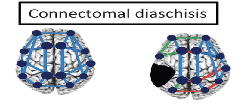 <p>Connectomal diaschisis</p>