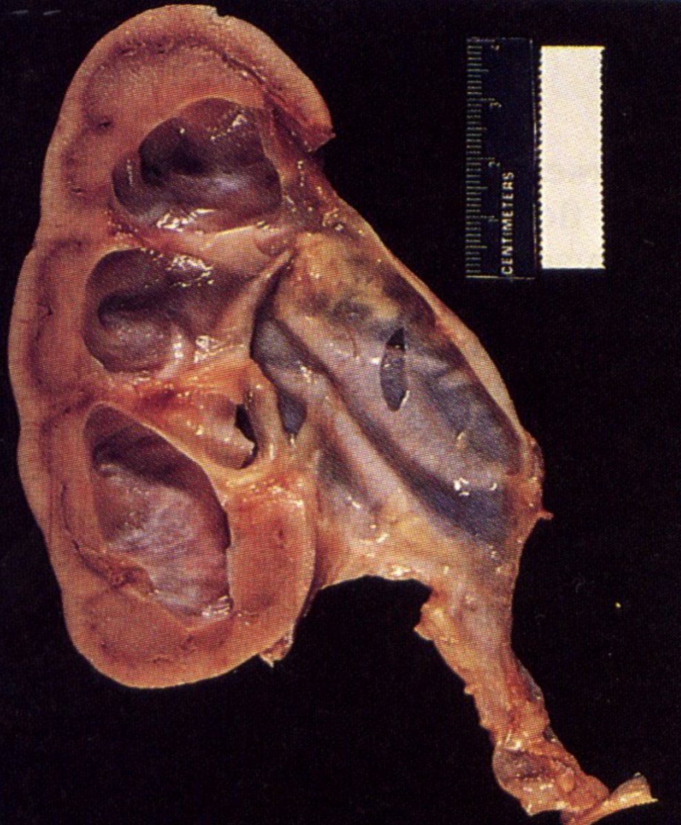 <p>Hydronephrosis</p>